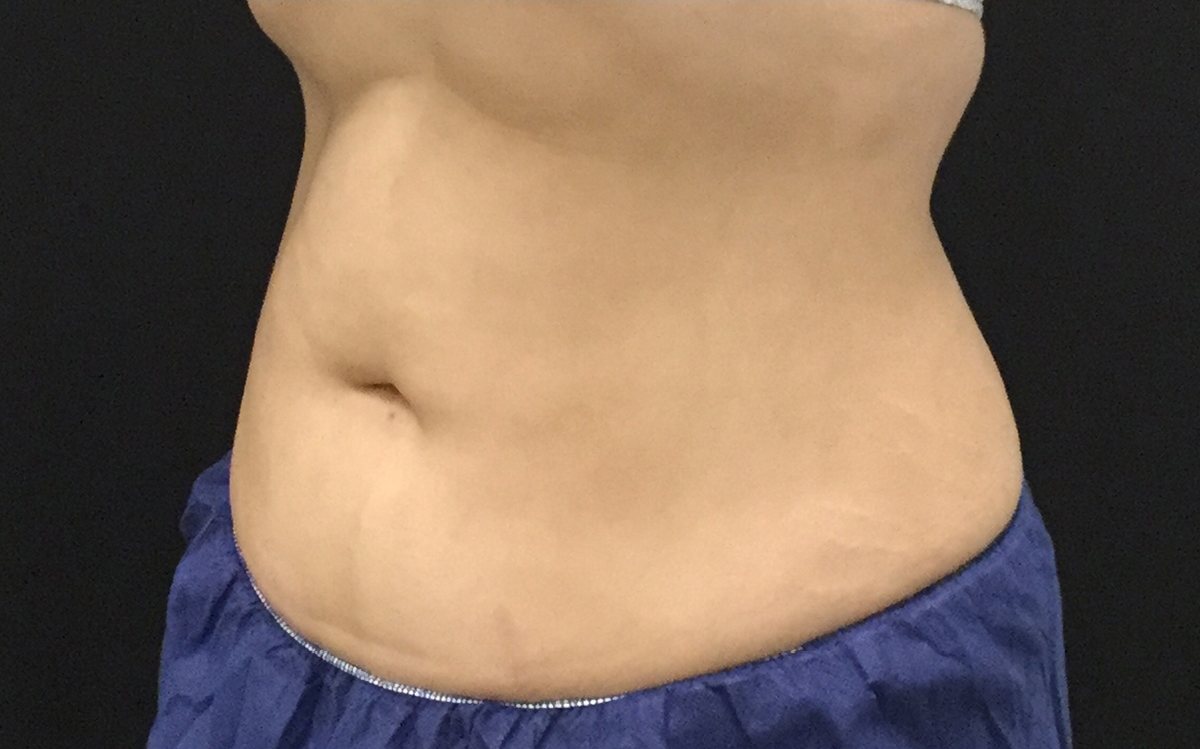 After Coolsculpting - Stomach