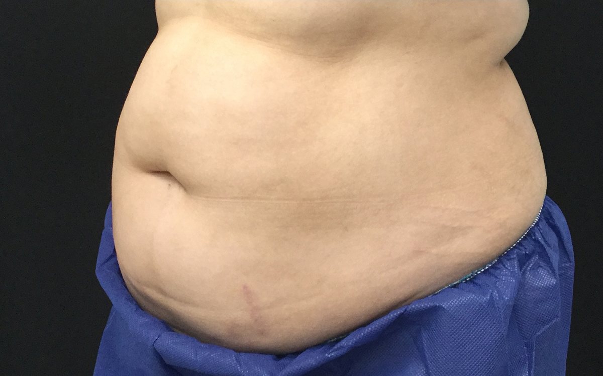 Before Coolsculpting - Stomach
